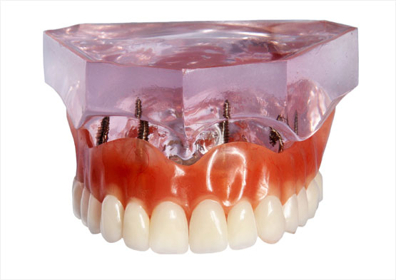 All-on-4 Dental Implants Torrance, CA