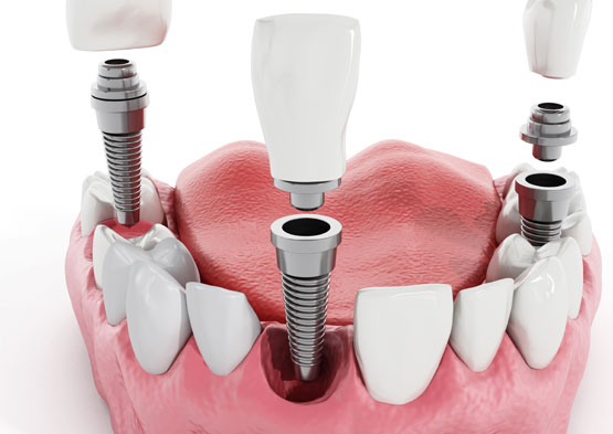 Intro to Dental Implants Torrance, CA